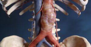Aortoiliac aneurysm: Understanding Risks and Treatment of Iliac Arteries