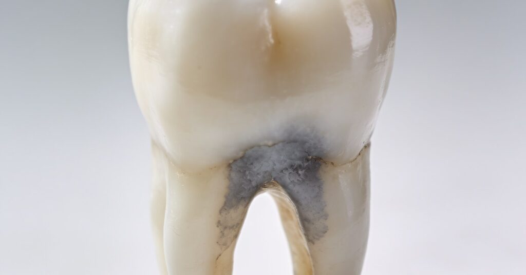 Symptoms of a dead tooth: Recognizing pulp necrosis and signs of decay