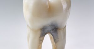 Symptoms of a dead tooth: Recognizing pulp necrosis and signs of decay