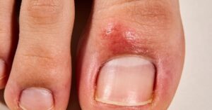 Gout symptoms NHS: Identifying pain in your big toe