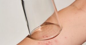 Flu and rash: Uncommon but existing symptoms among children