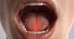 Red line in back of throat: Causes of sore throat and red streaks