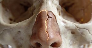 Broken nose treatment: Essential steps for a nasal fracture recovery