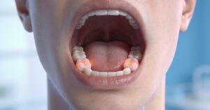 Herpangina in adults: Recognizing symptoms of this painful mouth disease